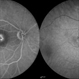 Chronic Central Serous Chorioretinopathy Chronic Central Serous Chorioretinopathy